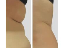 アモ(AMO)/#脂肪冷却#痩身#ダイエット