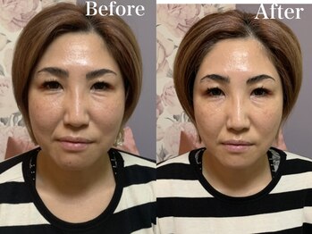 ルーチェ(LUCE)/小顔リフトUP/小顔矯正/筋膜