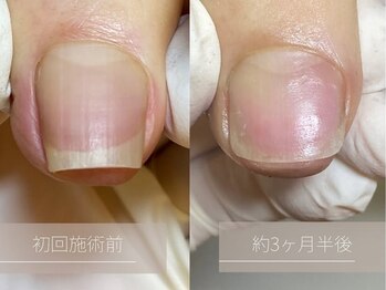 巻き爪・特殊な巻き爪