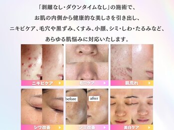 ホワイトアクア 新宿本店(WHITE AQUA)/ハーブピーリング/毛穴/新宿