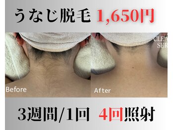 アップパイン(UPPINE)/うなじ脱毛¥1,650