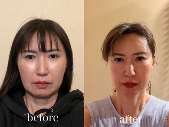 アリス(ALICE)/小顔矯正ビフォーアフター