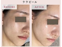 レクラ バイ ドクターエイチ(L'ECLAT by Doctor.H)/ララピール