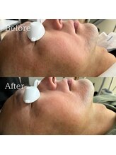 シェアキ(Chez Aki)/男性ヒゲ脱毛Before/After