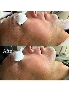 シェアキ(Chez Aki)/男性ヒゲ脱毛Before/After