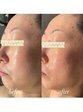 マージェ(magie)/【エクソソーム美容液】使用