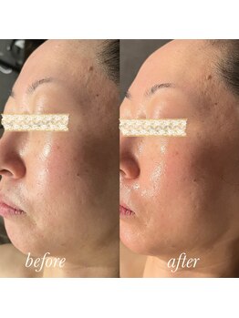 マージェ(magie)/【エクソソーム美容液】使用