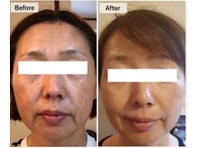 タビー(Tabby)の雰囲気（50代の方♪リアボーテ使用でここまでお綺麗に♪※個人差あり）