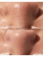 グレアージュ(GLEAGE)/くすみ毛穴レス水光肌コース！