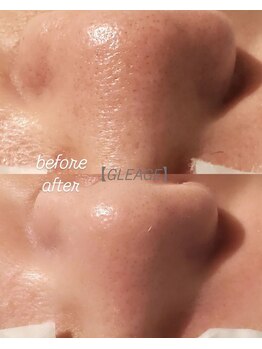 グレアージュ(GLEAGE)/くすみ毛穴レス水光肌コース!