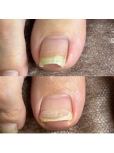 リリ(lili)/巻き爪矯正/1回目/右親指巻き爪