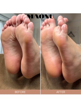 マオヌー(MAONU)/韓国式足裏角質ケア　症例写真