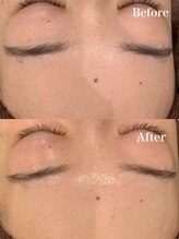 ツール(TOOL)/ハーブピーリング