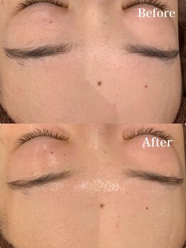 ツール(TOOL)/ハーブピーリング