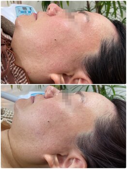 ニキビケア研究所 吉祥寺店/お肌質を変えたい方にも◎