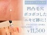 【凸凹毛穴・跡ケア】滑らかで均一な肌へプラズマシャワー美容液導入/14800→