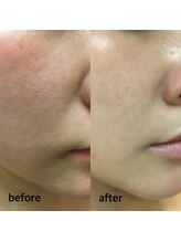 ルクソール/ルビィ陶肌ハーブピーリング