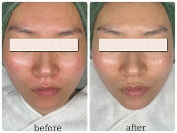 ベル(Bell)/ハーブピーリングbefore/after