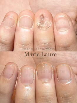 マリーロール 淀屋橋本店(Marie Laure)/自爪育成/深爪矯正/ネイルケア