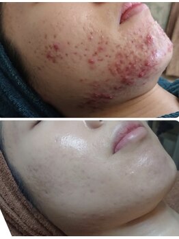 エル(Elle)/【にきびケア】頑固な顎・口周り