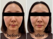 たたら鍼灸整骨院/40代女性　before / after