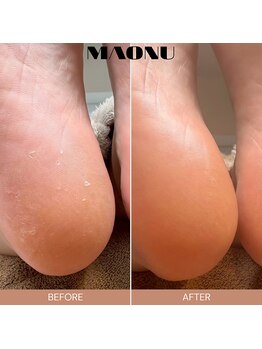 マオヌー(MAONU)/韓国式足裏角質ケア　症例写真