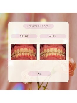 プラスビー 2号店(+b)/ホワイトニングビフォーアフター