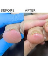 クオッカ(Quokka)/巻き爪ケア