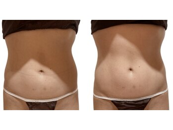 痩せラボ/おへその位置が変化【痩身】