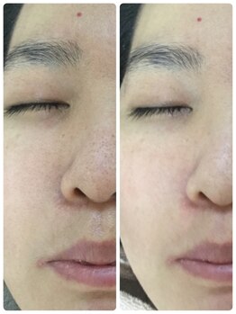 メイユール(MEILLEUR)/光フェイシャル