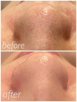 シス(SiS)/ハイドラ/毛穴開きケア