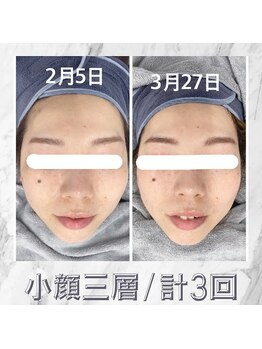 ハロ 南青山(HALO)/全顔小顔三層打ち☆3回目