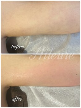 エルール トータルビューティ(Aileure total beauty)/ダウンタイムケア二の腕