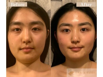 グレースフィオーレ 京橋店(gracefiore)/Before/After( 7回施術)