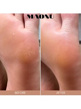 マオヌー(MAONU)/韓国式足裏角質ケア　症例写真