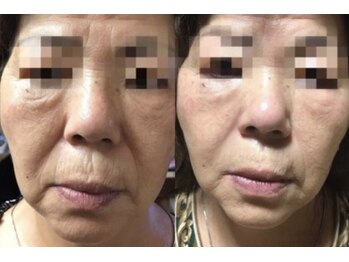 れふぇるん 足利店/60代しわ改善たるみ改善 施術1回