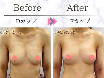メディカルサロン エム エム エム 大阪梅田グランドサロン(M.M.M)/【バストアップ例】　D→Fカップ