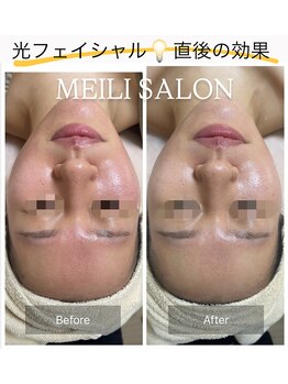 メイリー(MEILI)/光フェイシャル直後効果