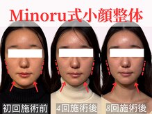 フレキシボディ(FlexiBody)/小顔施術ビフォーアフター #15