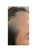 キュライム カブール町田店/生え際悩みにも