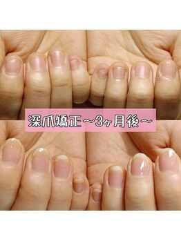 深爪矯正長さ出し～3ヶ月後～