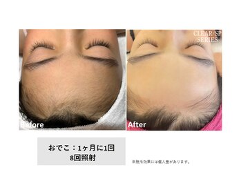 ミモザ(mimosa)の写真/親子で通える脱毛デビューは当サロンで◎ 痛みの少ない最新THR方式マシン導入♪細い毛まで徹底アプローチ!