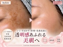 ラティーナ(Lattina)の雰囲気（【シミケア】韓国最先端技術！施術一回で完了♪）