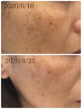 メイユール(MEILLEUR)/光フェイシャル