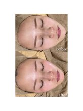 ミーミドットアイ(Mi-mi.i)/艶肌WAX脱毛＋炭酸ガスパック