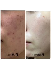 アネラ 本町(ANERA)/サロンケアとホームケアでの結果