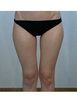 ヴィオラ(Viola)/痩身!キャビテーションEMS