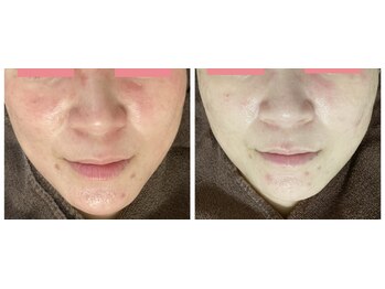 ビエル(Bielle)/彼に肌良くなったって言われた！