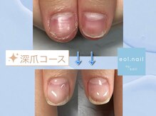 エオル(eol.)/深爪緩和コース