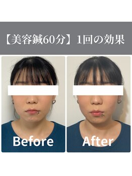 サンクエール 代官山鍼灸院(CINQ AILES)/美容鍼灸　小顔・浮腫み改善